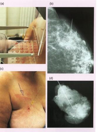 da Fast Facts-Breast cancer, Health Press, 2005 (3 ed.)